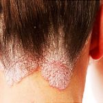 بهترین اسکین کر اصفهان | درمان بیماری پوستی پسوریازیس