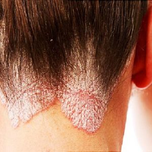 بهترین اسکین کر اصفهان | درمان بیماری پوستی پسوریازیس