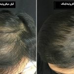 تاثیرات میکرونیدلینگ مو | بهترین لیزر موهای زائد اصفهان