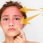 پیشگیری و درمان تاول آفتاب سوختگی | بهترین لیزر موی زاید اصفهان