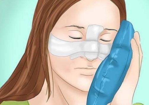 گذاشتن کمپرس یخ در اطراف بینی برای کاهش درد.