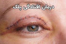 رفع افتادگی پلک در اصفهان