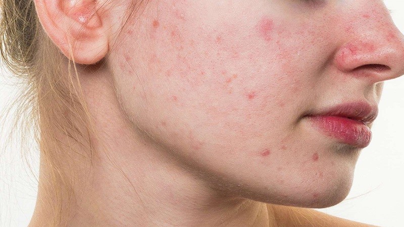 علت جوش پوست بعد از لیزر چیست؟